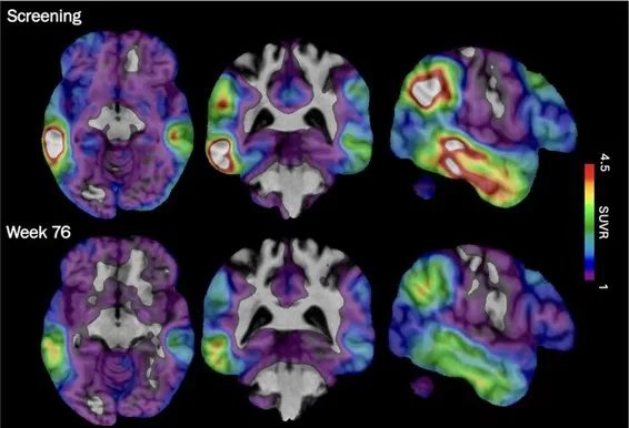 Biogen’s Tau-Targeting Drug Shows Promise in Shifting Alzheimer’s Treatment Frontier 1 Biogen Experimental Tau Drug Results