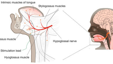 علاج مبتكر لانقطاع التنفس