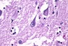 الزهايمر والنوم المبكر