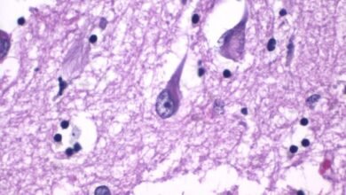 الزهايمر والنوم المبكر