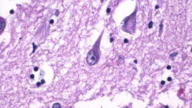 الزهايمر والنوم المبكر