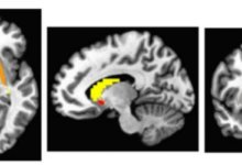 توحد-باركنسون-دوبامين