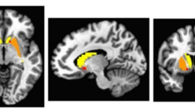 توحد-باركنسون-دوبامين