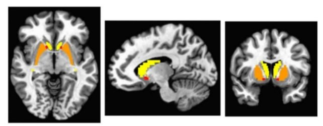 توحد-باركنسون-دوبامين