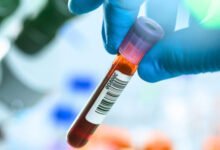 تراجع-وفيات-السرطان-بريطانيا