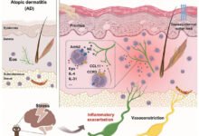 stress-eczema-nerve-pathway