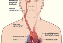 جيل-مغناطيسي-يمنع-السكتات