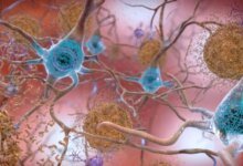 1774946064 New Alzheimers Treatment Strategy Reverses Cognitive Decline in Mice