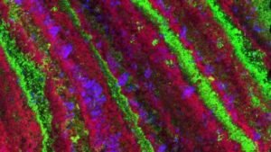 بكتيريا-حصوات-الكلى-اكتشاف-جديد