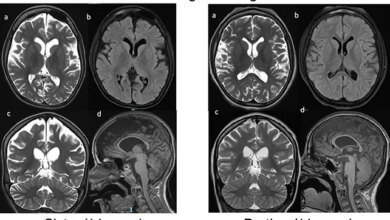 متلازمة ReNU2: جين صامت يكشف اضطرابًا عصبيًا جديدًا يضرب الآلاف 1 متلازمة ReNU2
