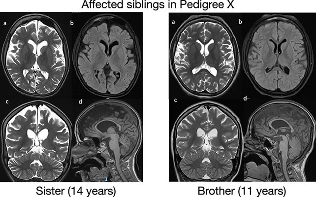 متلازمة ReNU2: جين صامت يكشف اضطرابًا عصبيًا جديدًا يضرب الآلاف 1 متلازمة ReNU2