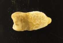 لغز المومياء والحمى القرمزية