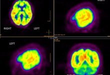 دم الزهايمر المبكر