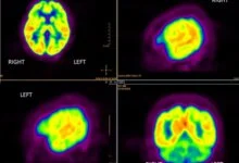 دم الزهايمر المبكر