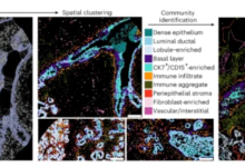 تحولات خلايا الثدي والسرطان