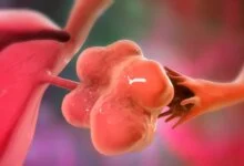 نهاية عصر تكيس المبايض
