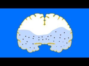 نظام تنظيف الدماغ والخرف