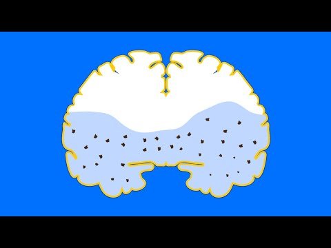 نظام تنظيف الدماغ والخرف