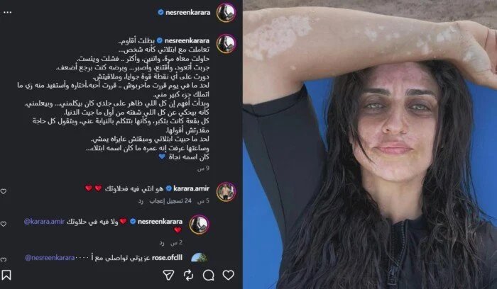 نسرين كرارة والبهاق