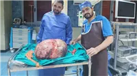 جراحة نادرة في الصعيد.. استئصال ورم مبيضي يزن 24 كيلوجرامًا بجامعة المنيا 2 استئصال ورم عملاق بالمنيا